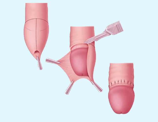 Circumcision