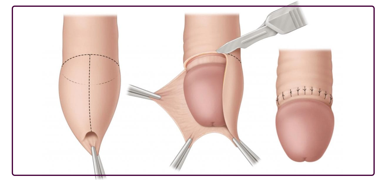 Circumcision