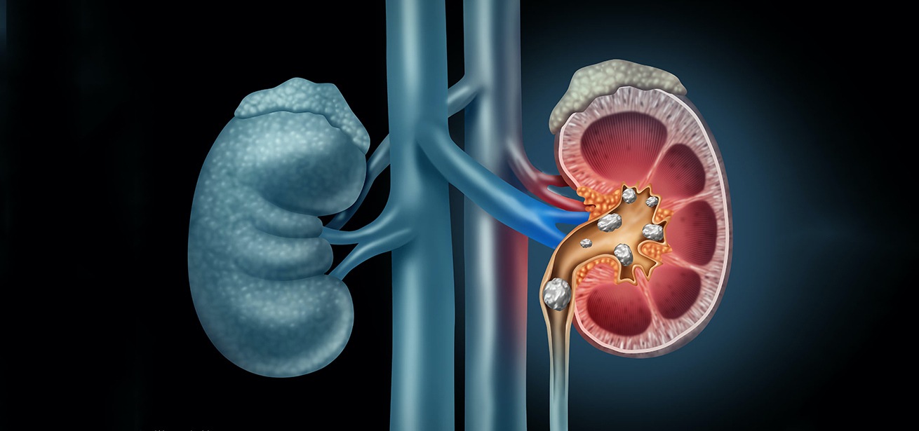 Kidney Stone