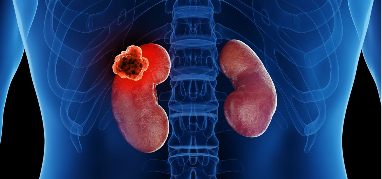 Kidney Tumor
