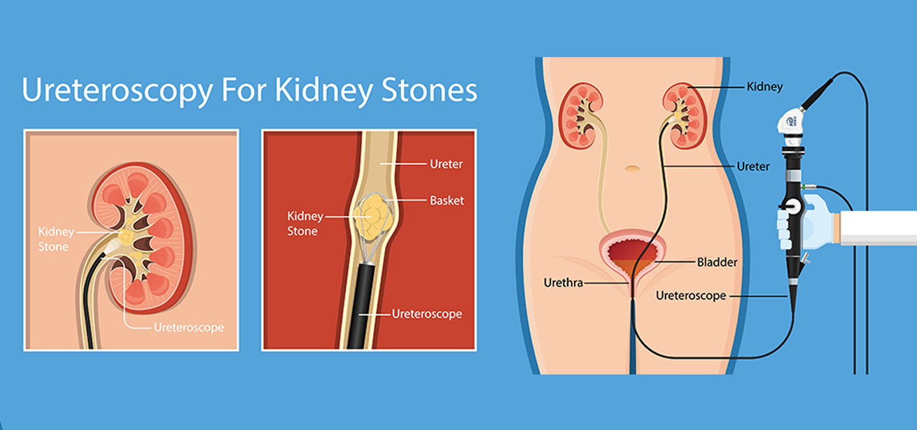 Ureteroscopy