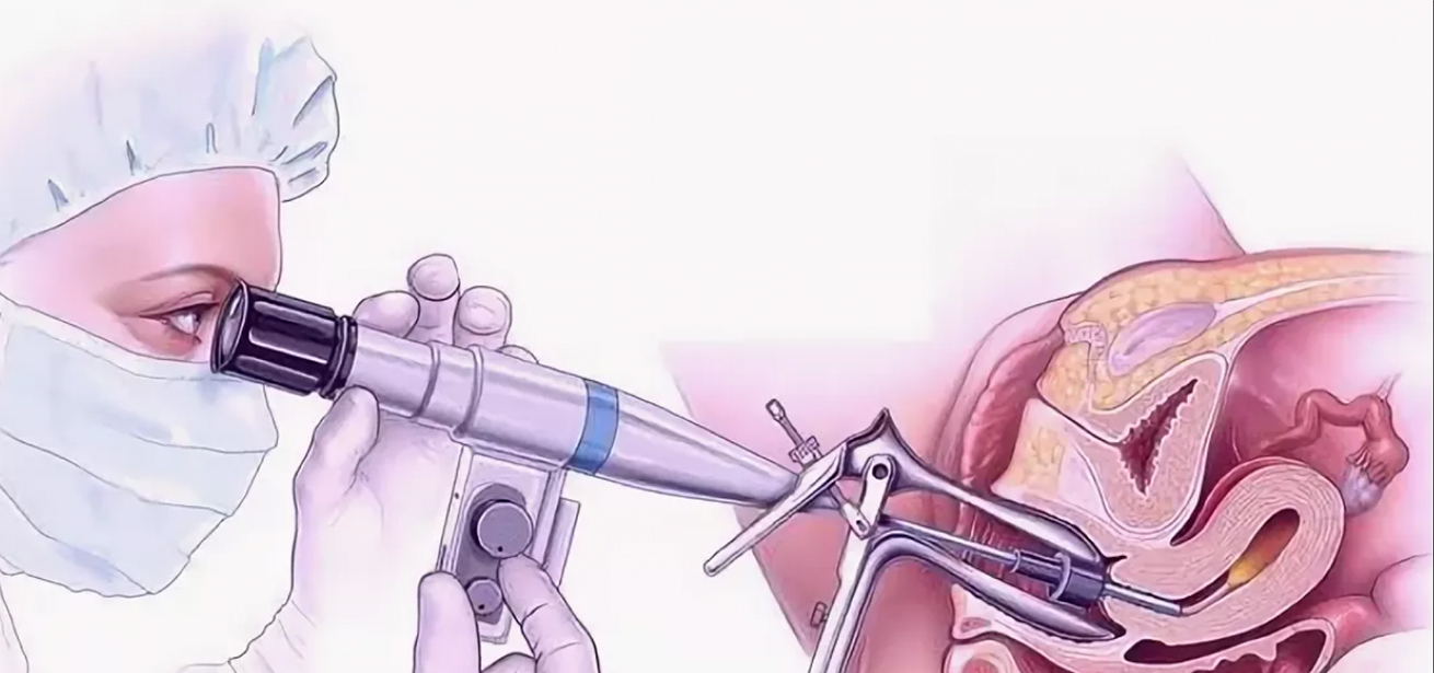 Visualized Internal Urethrotomy
